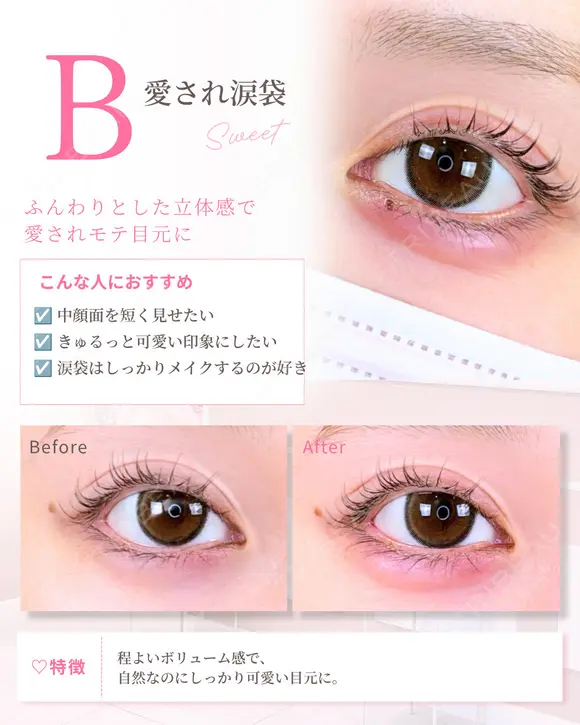 涙袋ヒアルロン酸 after画像 メイン用