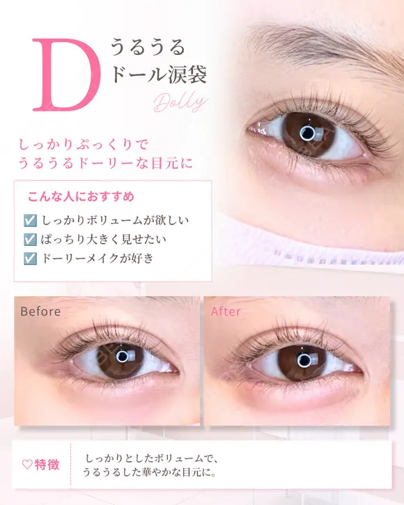 涙袋ヒアルロン酸 before画像 メイン用