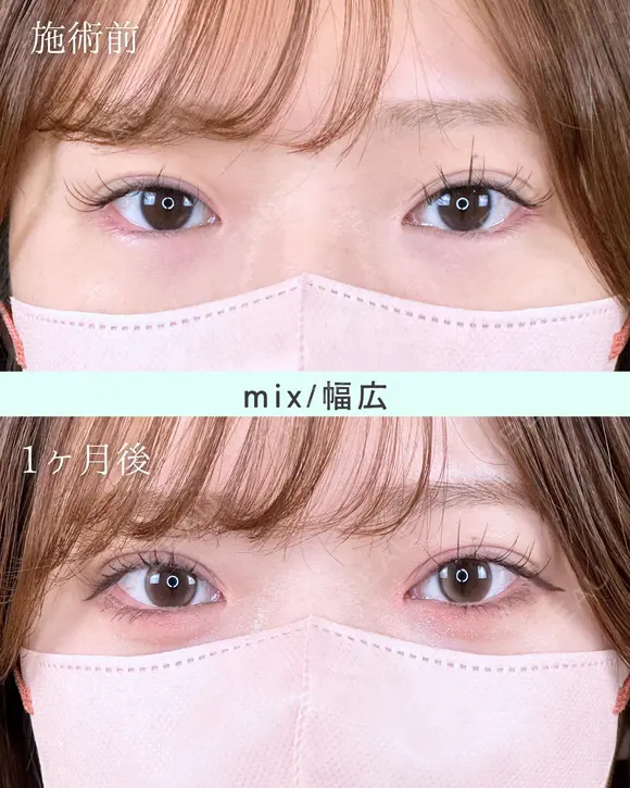 エターナル二重術(自然癒着法) before画像 メイン用