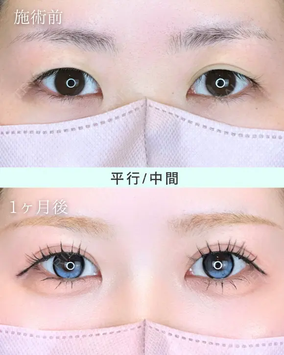 エターナル二重術(自然癒着法) before画像 メイン用