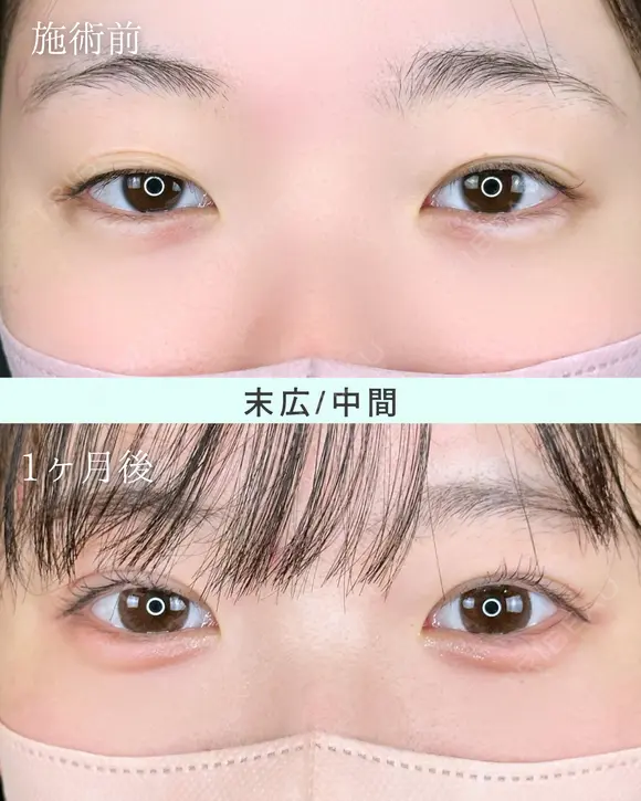 エターナル二重術(自然癒着法) after画像 メイン用