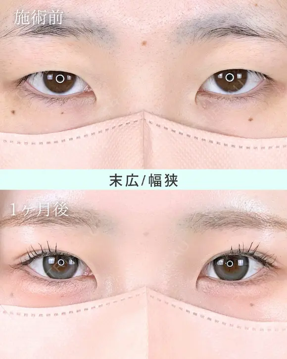 エターナル二重術(自然癒着法) after画像 メイン用