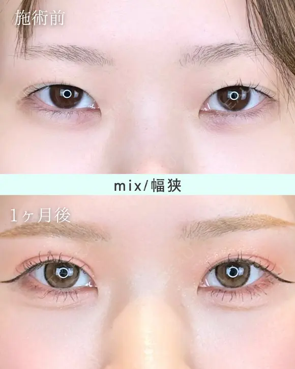 エターナル二重術(自然癒着法) before画像 メイン用