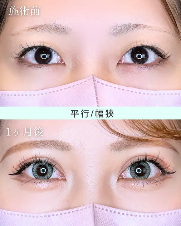 エターナル二重術(自然癒着法) after画像 メイン用