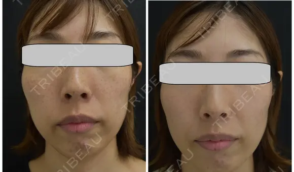 IPL光治療　1回 before画像 メイン用