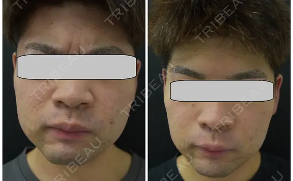 ケミカルピーリング＋エレクトロポレーション（Taプラス）3回＋イソトレチノイン3ヶ月 before画像 メイン用