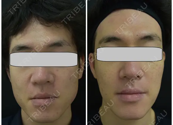 ケミカルピーリング＋エレクトロポレーション（Taプラス）3回＋イソトレチノイン3ヶ月 before画像 メイン用