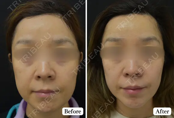 トライアルHIFU2回コース before画像 メイン用