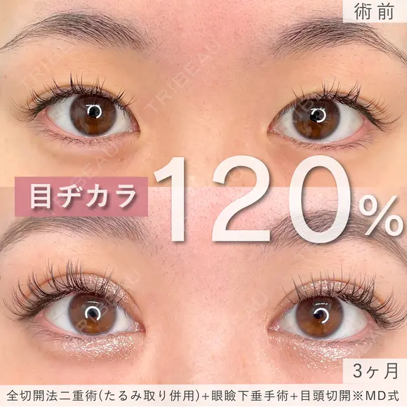 1週間でもう可愛い♡MD式全切開法二重術+MD式眼瞼下垂手術※たるみ取り併用 before画像 メイン用