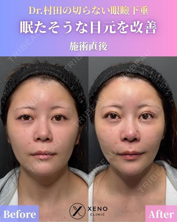 【施術直後】切らない眼瞼下垂 before画像 メイン用