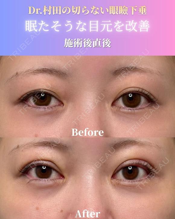 【施術直後】切らない眼瞼下垂 0日後 メイン用