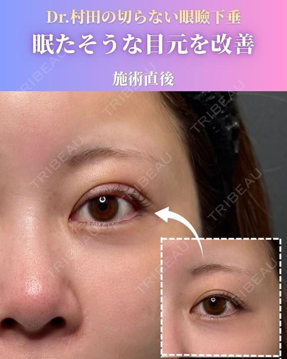 【施術直後】切らない眼瞼下垂 0日後 メイン用