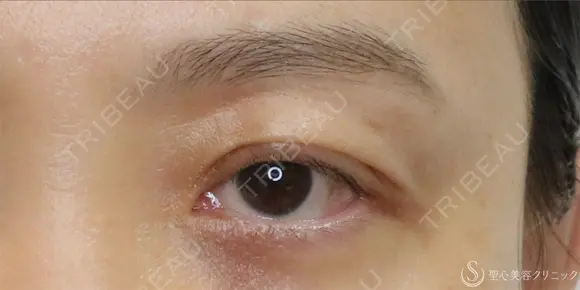 【40代女性・切らずに目の開き改善】眼瞼下垂埋没法（左のみ）（1ヶ月後） 30日後 メイン用