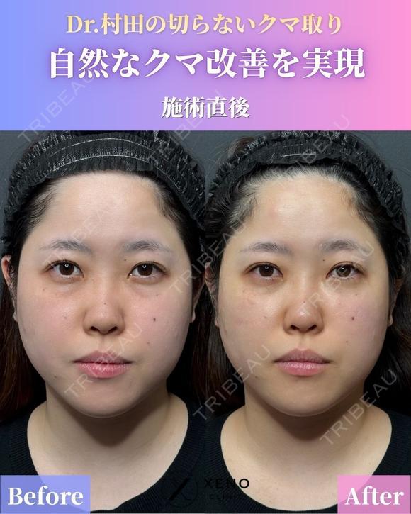 【施術直後】切らないクマ取り before画像 メイン用