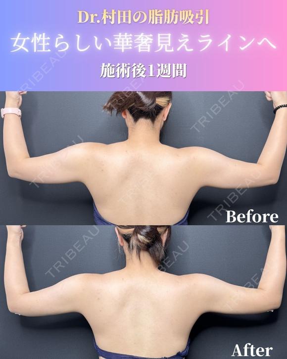 二の腕＋肩脂肪吸引 before画像 メイン用
