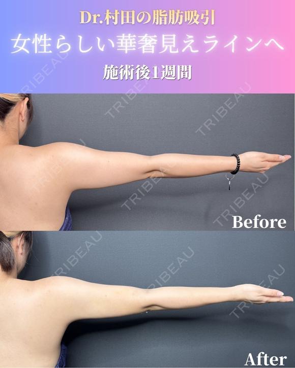 二の腕＋肩脂肪吸引 7日後 メイン用