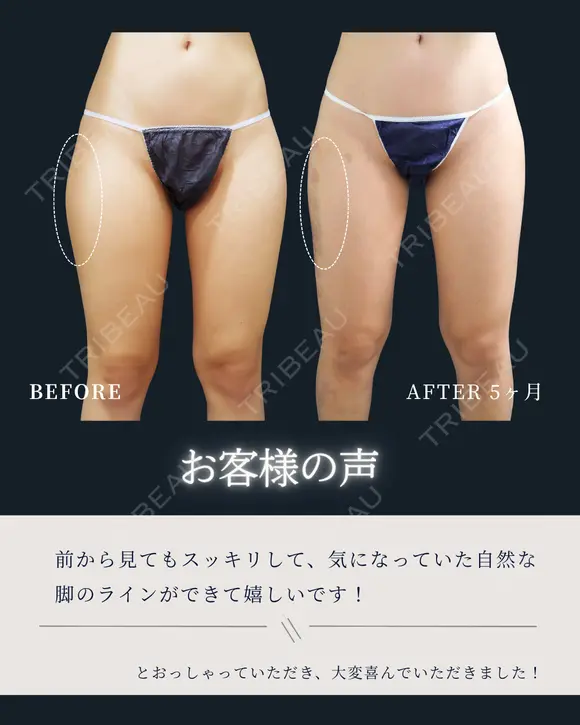 韓国アイドルのような美脚に！✨💓 after画像 メイン用