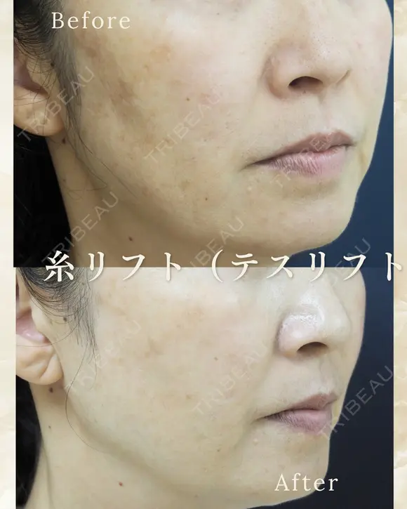 糸リフト（テスリフト） after画像 メイン用