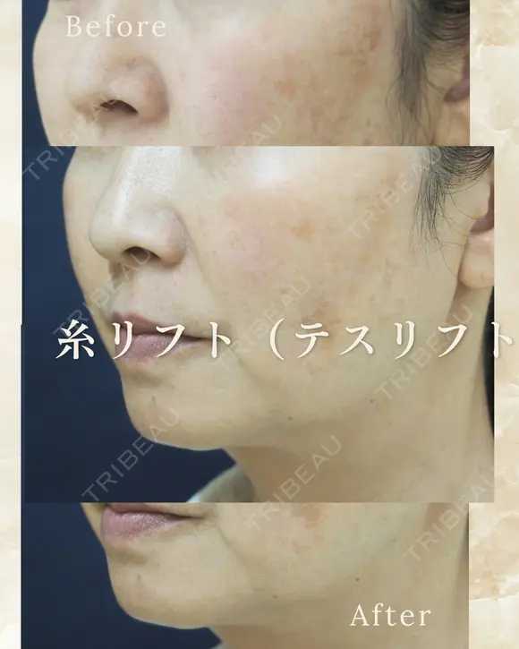 糸リフト（テスリフト） after画像 メイン用