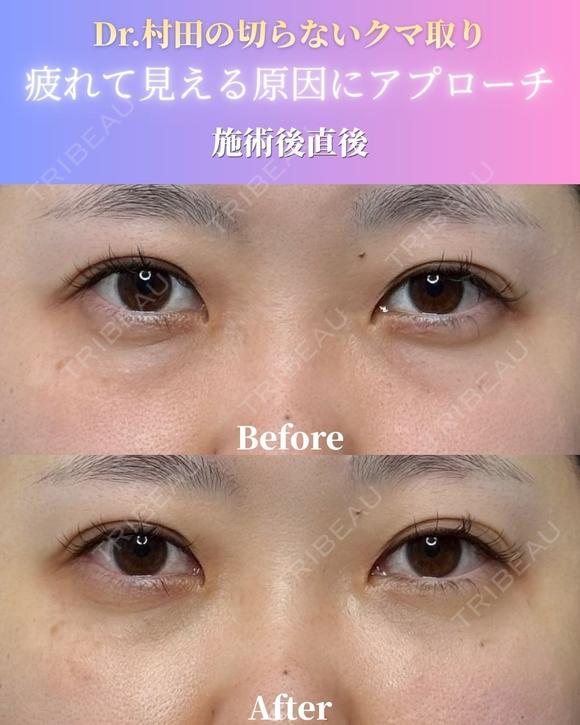【施術直後】切らないクマ取り 0日後 メイン用
