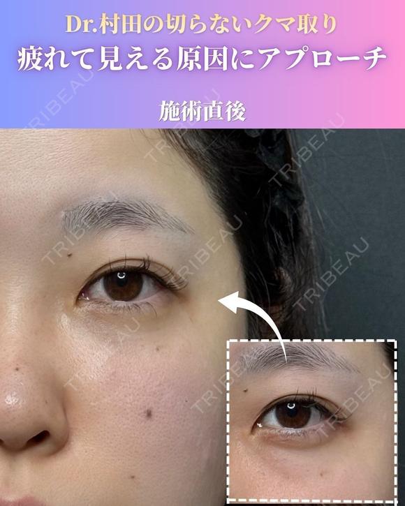 【施術直後】切らないクマ取り 0日後 メイン用