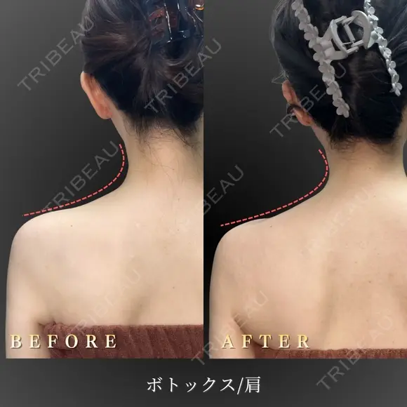 肩ボトックス after画像 メイン用
