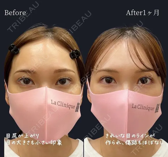 目尻靭帯移動＋目尻切開 before画像 メイン用