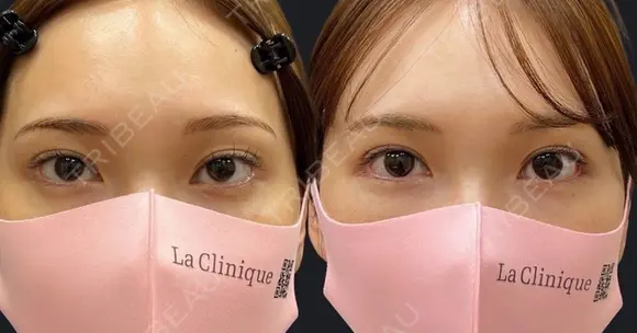 目尻靭帯移動＋目尻切開 after画像 メイン用