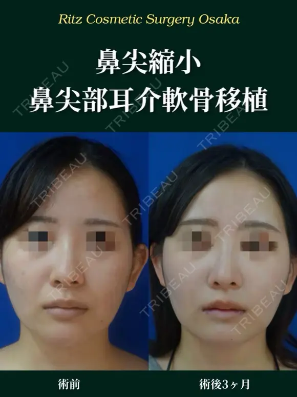 鼻尖形成＋鼻尖部耳介軟骨移植 before画像 メイン用