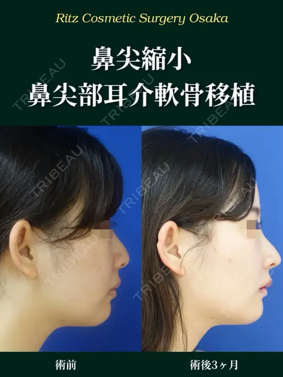 鼻尖形成＋鼻尖部耳介軟骨移植 after画像 メイン用