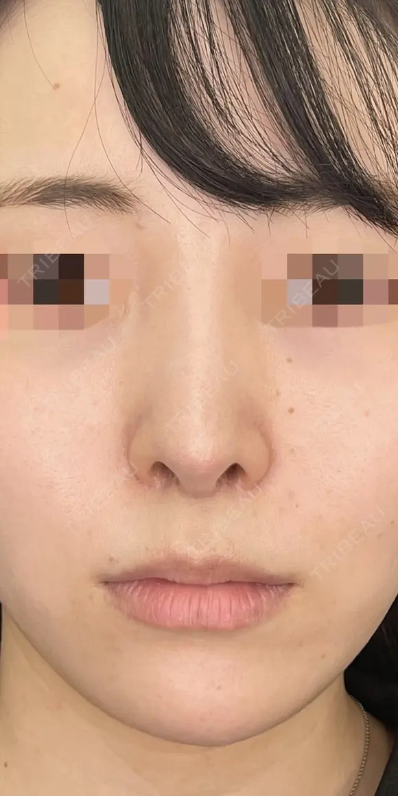 耳介軟骨移植+鼻尖形成 90日後 メイン用