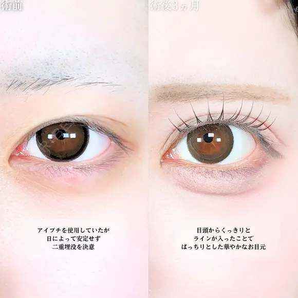 アリエルクイックループトリプル二重埋没法/涙袋ヒアルロン酸 before画像 メイン用