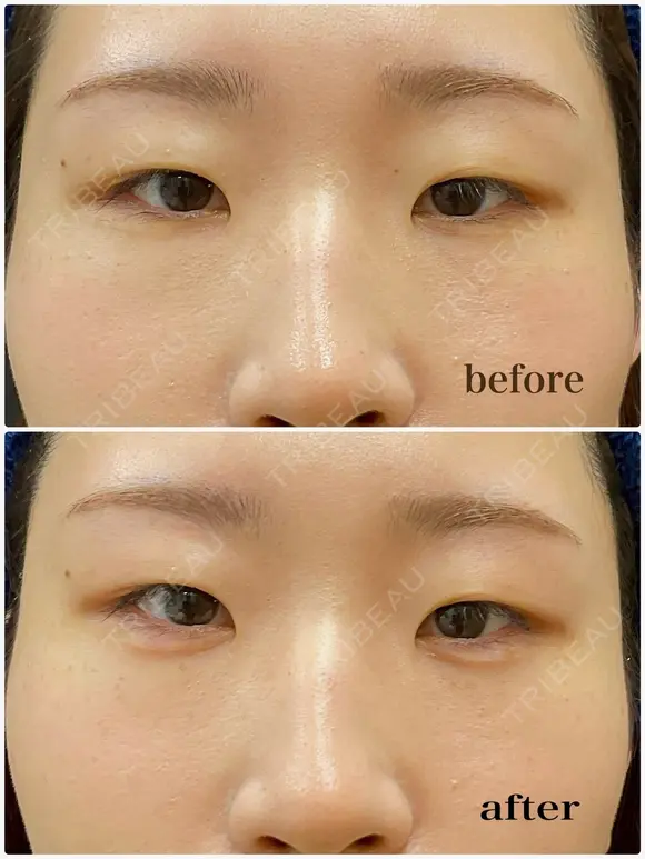 涙袋ヒアルロン酸 before画像 メイン用