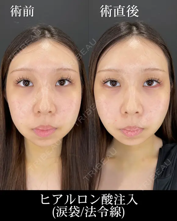 ヒアルロン酸注入（涙袋/法令線） before画像 メイン用