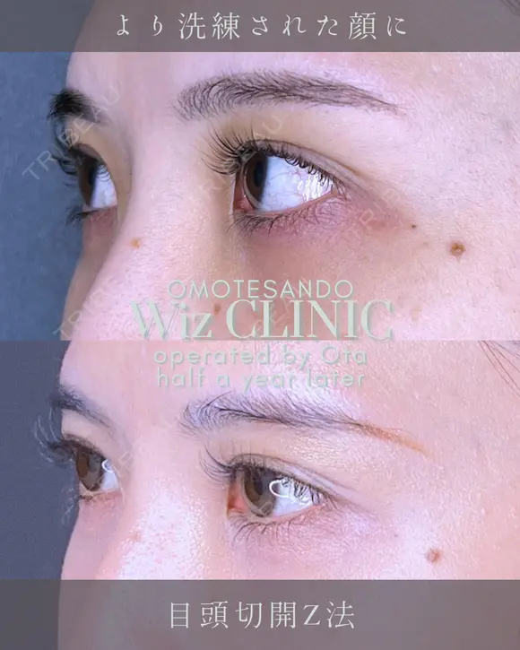 目頭切開Z法 after画像 メイン用