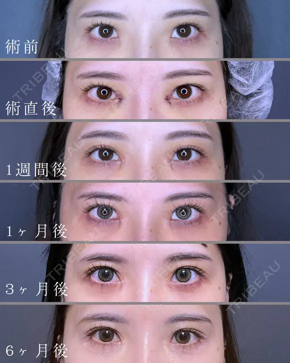 目頭切開Z法 after画像 メイン用