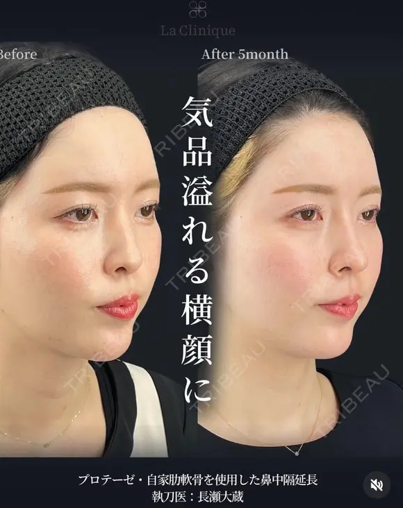 鼻フル（プロテーゼ＋鼻先grade３） after画像 メイン用