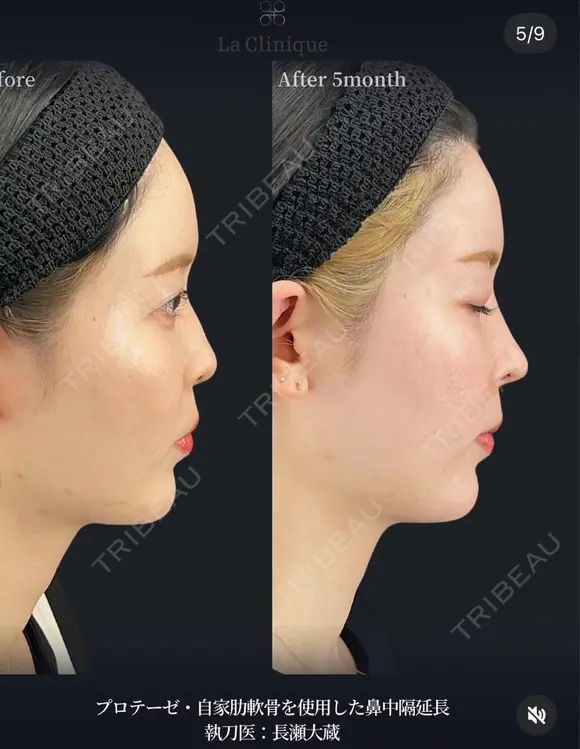 鼻フル（プロテーゼ＋鼻先grade３） before画像 メイン用