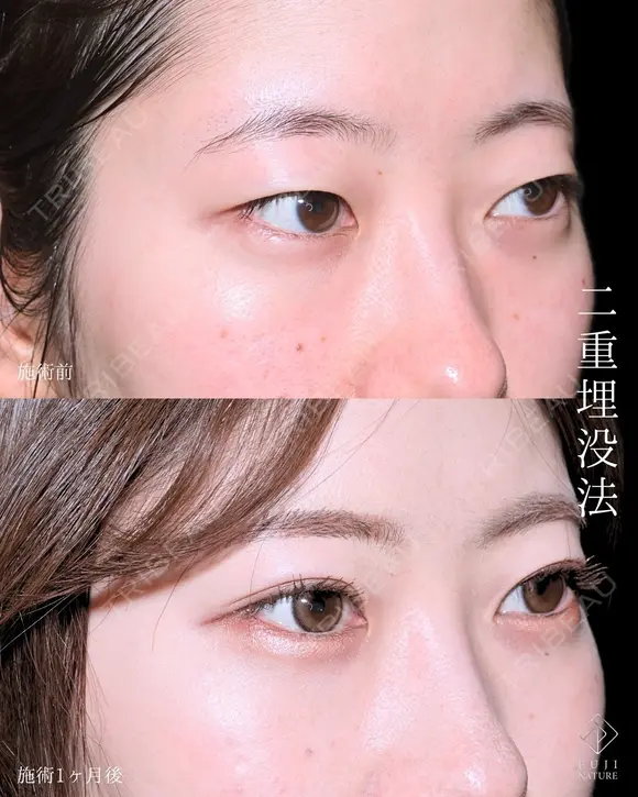 選べるオーダメイド二重埋没法 after画像 メイン用