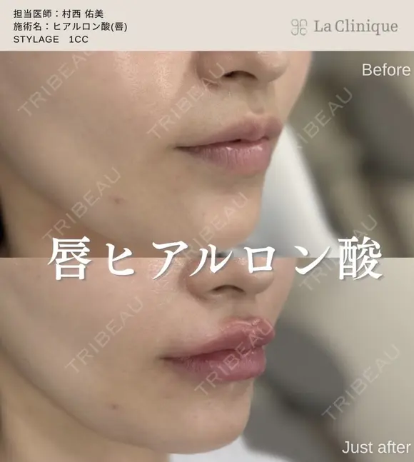 唇ヒアルロン酸 before画像 メイン用