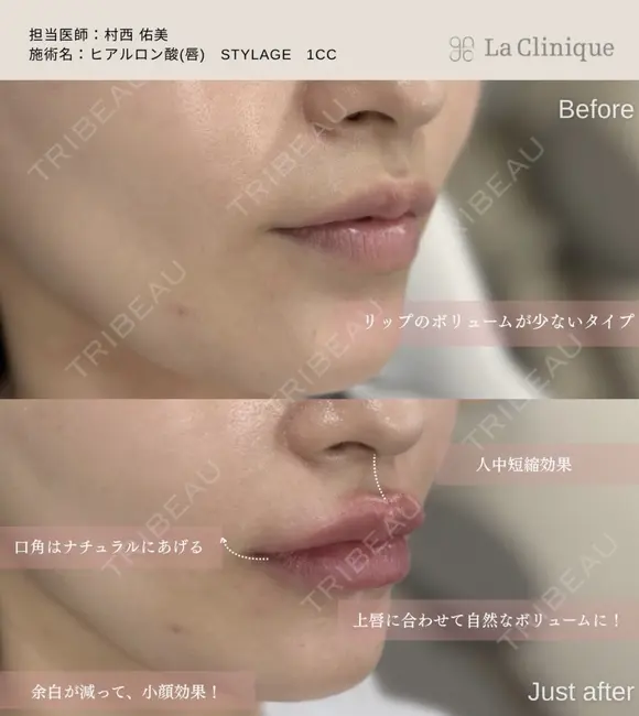 唇ヒアルロン酸 after画像 メイン用