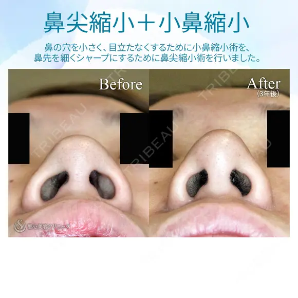 【20代女性・ダンゴ鼻＆大きな小鼻】鼻尖縮小術+α法＆小鼻縮小術+α法 before画像 メイン用