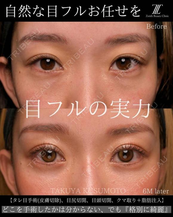 目フルの実力 180日後 メイン用