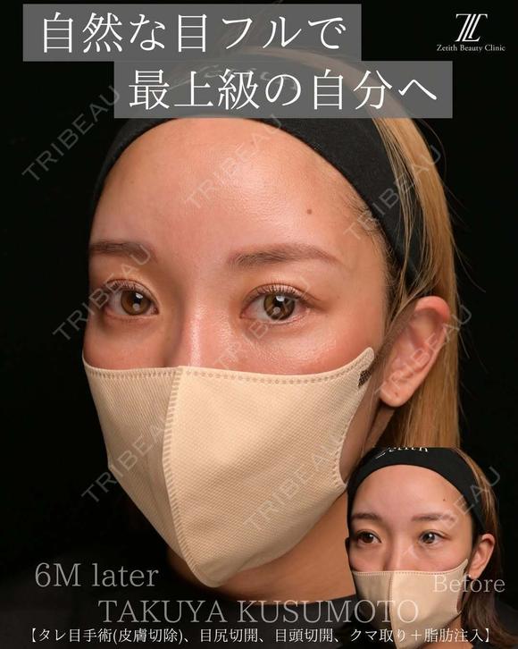 目フルの実力 180日後 メイン用