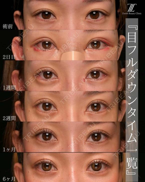 目フルの実力 180日後 メイン用
