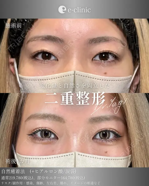 二重整形×涙袋 after画像 メイン用