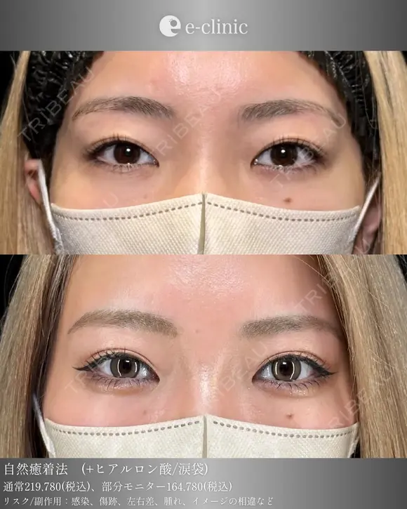 二重整形×涙袋 before画像 メイン用