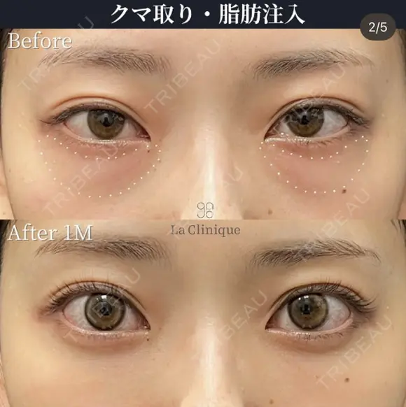 🧸切らない目の下たるみ取り・脂肪注入 after画像 メイン用