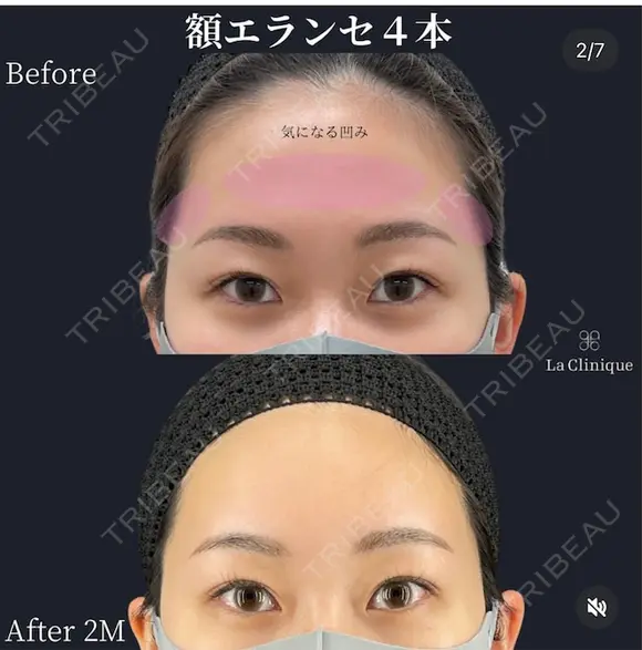 額エランセ　（デコンセ） after画像 メイン用