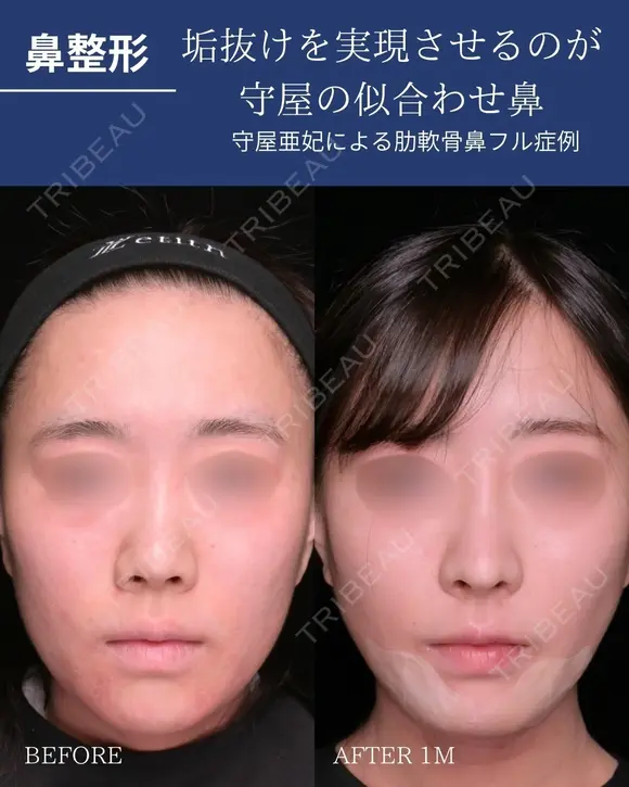 肋軟骨鼻フル 30日後 メイン用